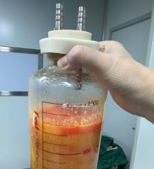 宿州水动力吸脂手术要做多久？